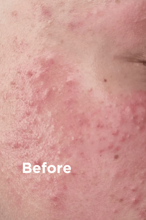 Sea Magik Mild Exfoliant 75ml i plast, nærbilde av hud med rødhet og kviser, før bruk