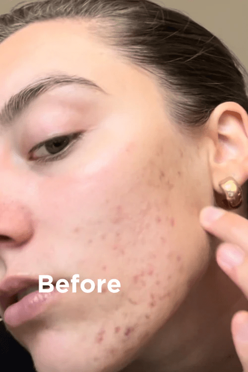 Sea Magik Mild Exfoliant 75ml i plast, nærbilde av ansikt med kviser og rødhet før bruk