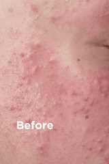 Sea Magik Mild Exfoliant 75ml i plast, nærbilde av hud med rødhet og kviser, før bruk
