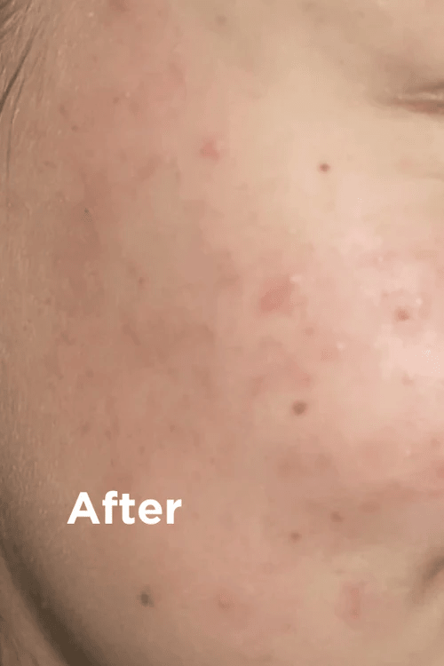 Sea Magik Mild Exfoliant 75ml, nærbilde av ansiktshud med redusert rødhet og kviser etter bruk