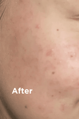 Sea Magik Mild Exfoliant 75ml, nærbilde av ansiktshud med redusert rødhet og kviser etter bruk