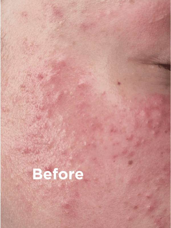 Sea Magik Rich Moisturiser 75 ml hvit i plast, nærbilde av rød og irritert hud med teksten "Before